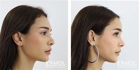 Forehead Implant Kamol Cosmetic Hospital