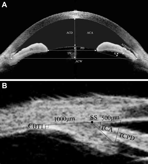 Subclassification Of Primary Angle Closure Using Anterior Segment