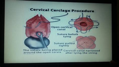 Abdominal Cerclage Vs Cervical Cerclage