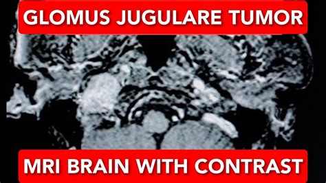 MRI Brain Anatomy Glomus Jugulare Tumor YouTube