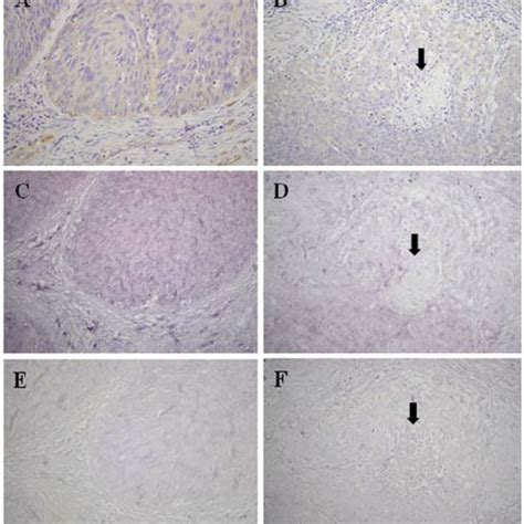 Cervical Cancer Cell Lines And Transfection Of Nestin Expression Vector