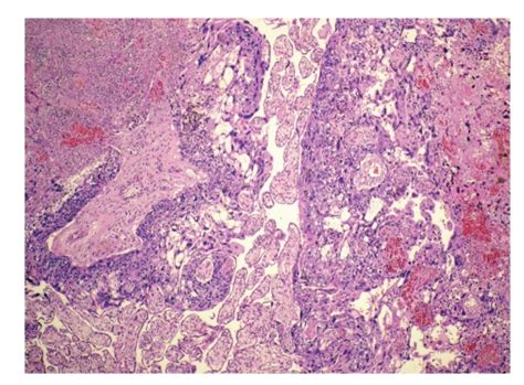 Intraplacental Choriocarcinoma Growing Out From Stem Villi Sharply