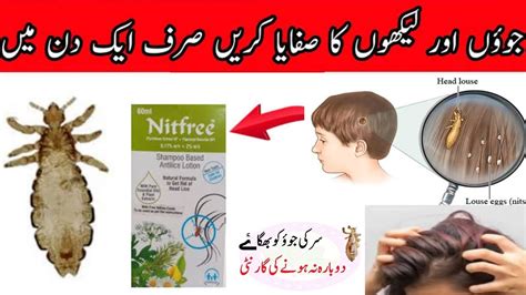 Sar Ki Juen Khatam Karne Ka Tarika Remove Lice Permanently