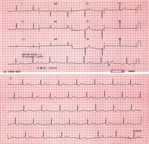 case   degree av block  junctional escape rhythm st emlyn