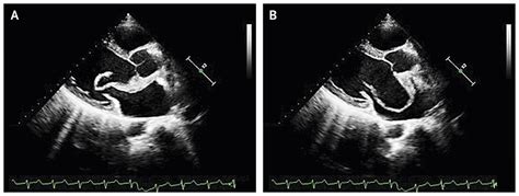 Mitral Valve Prolapse