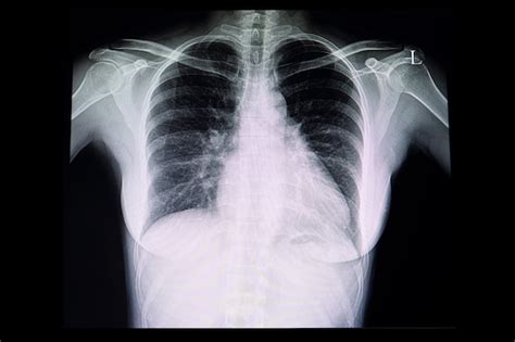 Premium Photo A Chest X Ray Film Of A Patient With Cardiomegaly