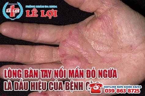 Lòng bàn tay nổi mẩn đỏ ngứa là dấu hiệu của bệnh gì