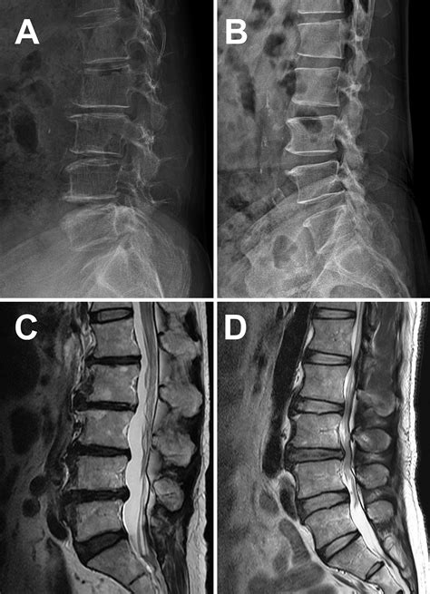 Diagnostic Triage In Patients With Central Lumbar Spinal Stenosis Using A Deep Learning System