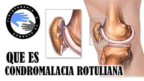 Condromalacia Rotuliana Grado Iv Causas S Ntomas Y Tratamiento