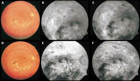 Fundus Photography And Fluorescein Angiography Of A Choroidal