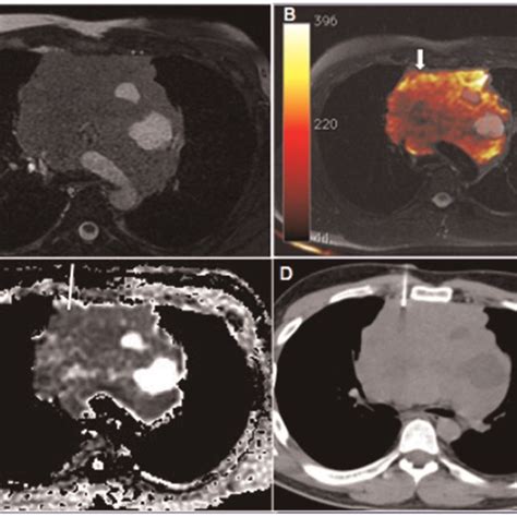 A 35-year-old man with a large mass in the anterior mediastinum. The ...