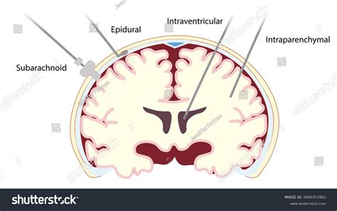 300 Intracranial pressure Images, Stock Photos & Vectors | Shutterstock