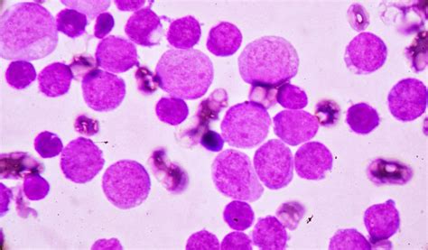 Leucemia Mieloide Aguda Sintomas E Tratamento Blog Nav Dasa