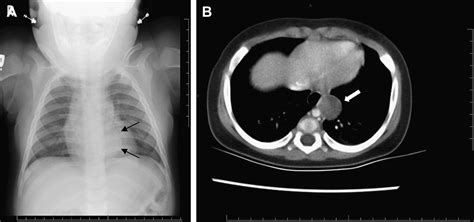 Mediastinal Tumors And Cysts In The Pediatric Population Thoracic