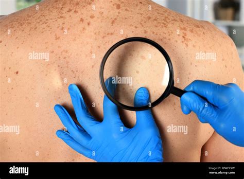 Dermatologist Examining Patient S Birthmark With Magnifying Glass