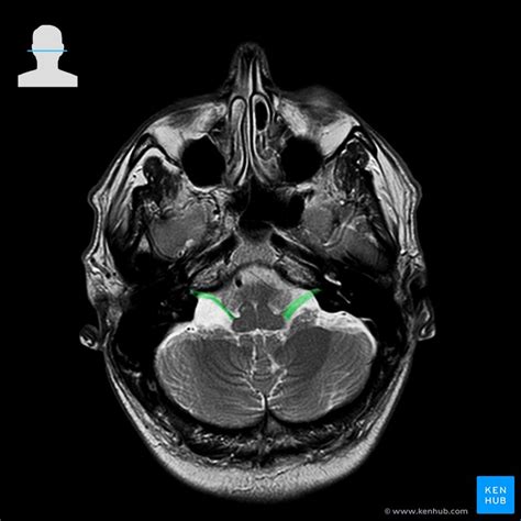 Vestibular Nerve Mri