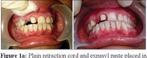 Comparison Of Gingival Retraction Produced By Retraction Cord And