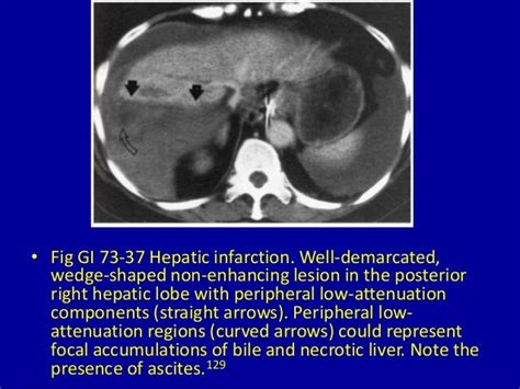 73 Focal Decreased Attenuation Masses In The Liver