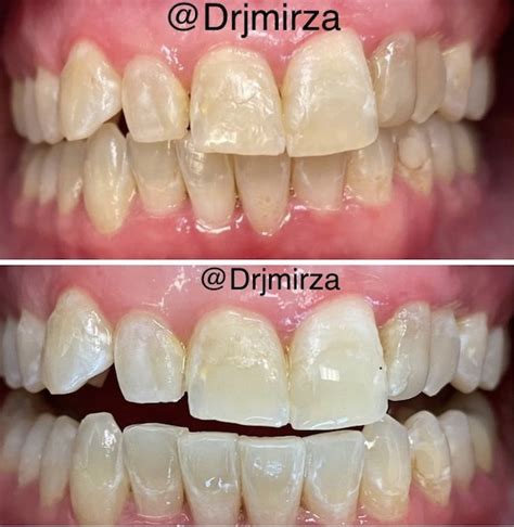 Before After Dental Treatments Dentist In Greensboro North Carolina