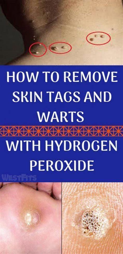Pin on Natural Way To Remove Warts