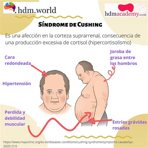 Enfermedad De Cushing