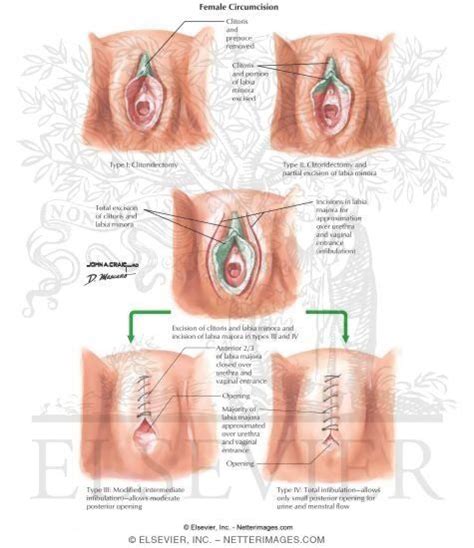 Types Of Circumcision Styles Free Porn