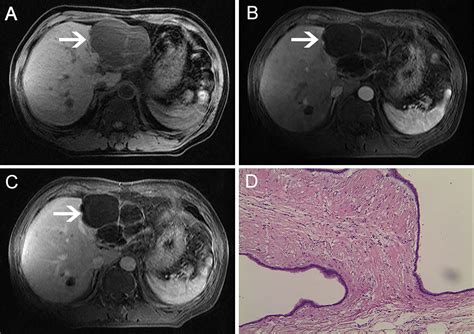 Frontiers Case Report Low Dose Apatinib In The Treatment Of