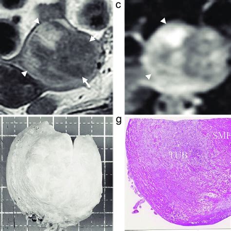 A 45 Year Old Woman With Uterine Adenomatoid Tumor Lesion 3 A A