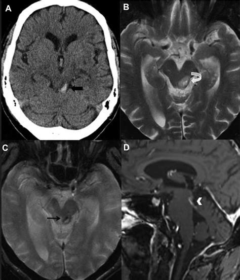 Quadrigeminal Cistern Lipoma