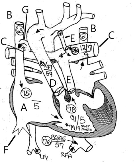 Cardiac Diagram Showing Anatomy Oxygen Saturation And Pressures