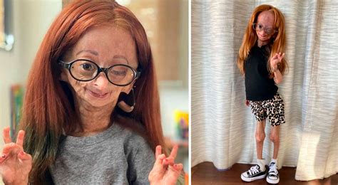 Adalia Rose Williams Murió Youtuber De 15 Años Que Padecía El Síndrome