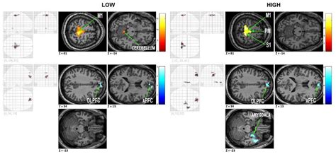 Modulation Of Cortical And Subcortical Brain Areas At Low And High