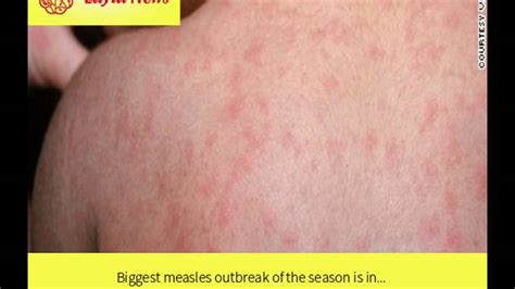 Biggest Measles Outbreak Of The Season Is In By Cnn Youtube