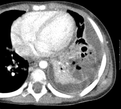 Role Of Routine Computed Tomography In Paediatric Pleural Empyema Thorax