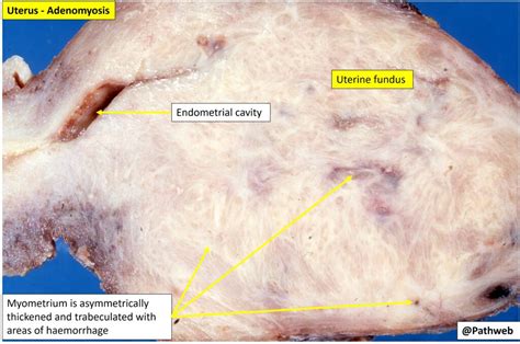 Uterus Adenomyosis Nus Pathweb Nus Pathweb