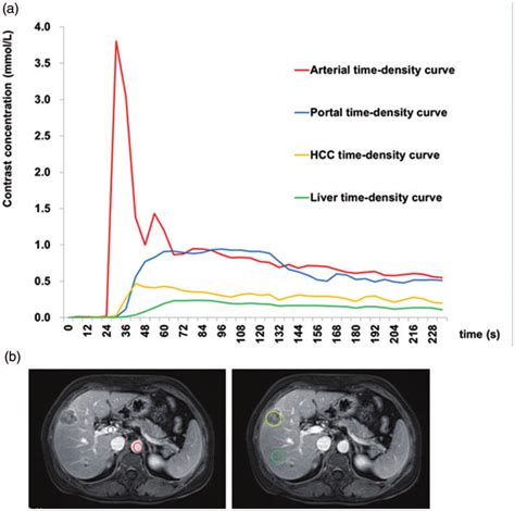 Dynamic Contrast Enhanced Magnetic Resonance Imaging Of A 51 Year Old