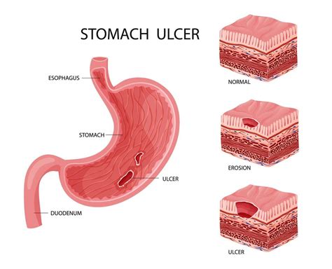 Stomach Erosion And Ulcer Illustration Vector Art At Vecteezy