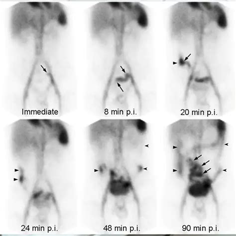 Gi Bleed Scan Procedure Best Gi Bleed Scan In Delhi Ganesh Diagnostic