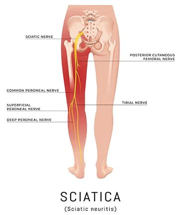 Sciatica Pain Causes And Sciatica Exercises – Healthcare for You