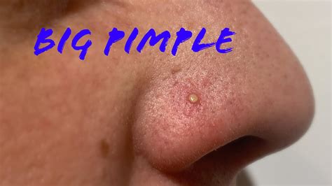 [big Pimple] Big Pimple Popping On Nose Youtube