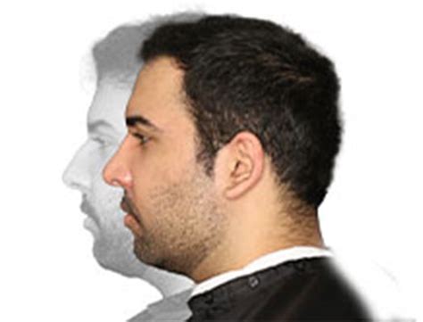 Male Rhinoplasty 01 Dr Monica Tadros Sinus Sleep Facial