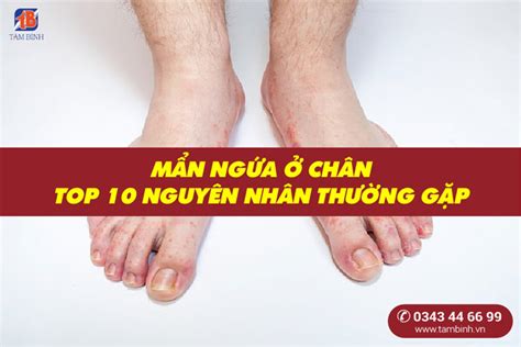 Nguyên nhân và cách khắc phục ngứa chân nổi mẩn hiệu quả