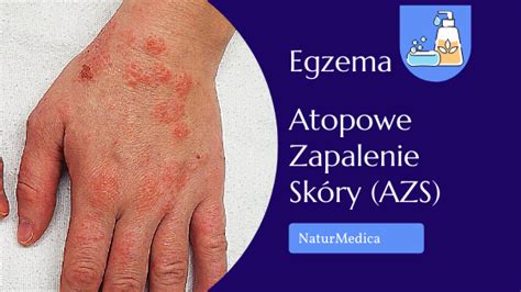 Egzema I Atopowe Zapalenie Sk Ry Azs Naturmedica