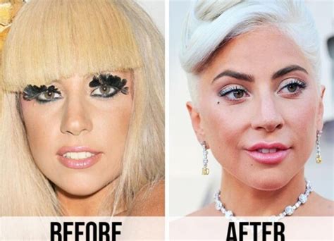 Lady Gaga Plastic Surgery Everything The Actress Singer Has Admitted