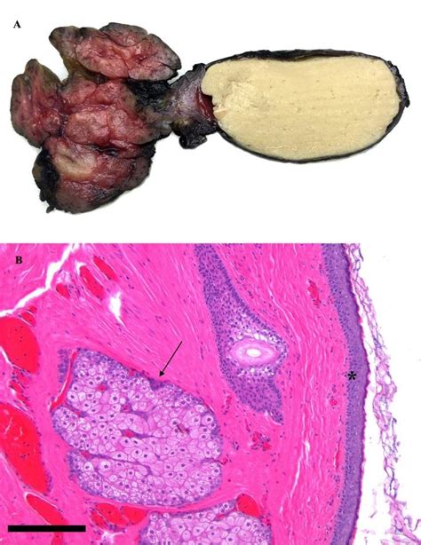 Left 17 Year Old Female With A Dermoid Cyst In The Left Oral Cavity