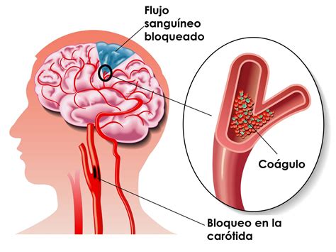 Cuáles pueden ser las causas comunes de un accidente cerebrovascular