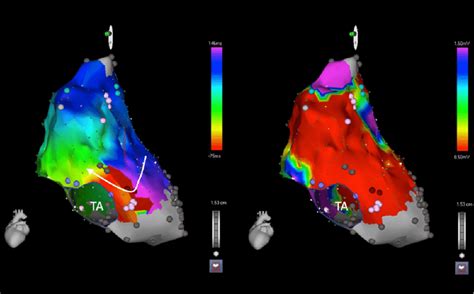 This Figure Shows Electroanatomic Maps In A Patient With Iart Post