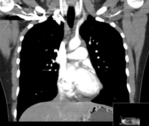 Adult Chest Radiograph Reporting By Radiographers Preliminary Data