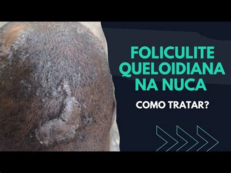 Como Tratar Foliculite Queloidiana Na Nuca Saiba Youtube