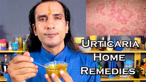 Urticaria Treatment Urticaria Home Remedies By 2 Kitchen Ingredients Youtube